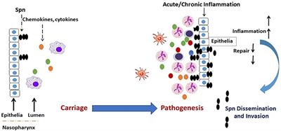 Role of Inflammatory Risk Factors in the Pathogenesis of Streptococcus pneumoniae